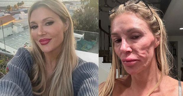 Brandi Glanville, Meme İmplantlarının Yüz Deformasyonuna Neden Olduğunu Açıkladı