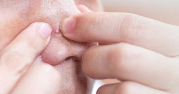 Uzmanlar Uyarıyor: Çıban Sıkmak Enfeksiyonu Yayabilir