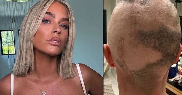 Teddi Mellencamp Kanserle Mücadelede Yara İzlerini Gururla Gösterdi: Peruklardan Yoruldum